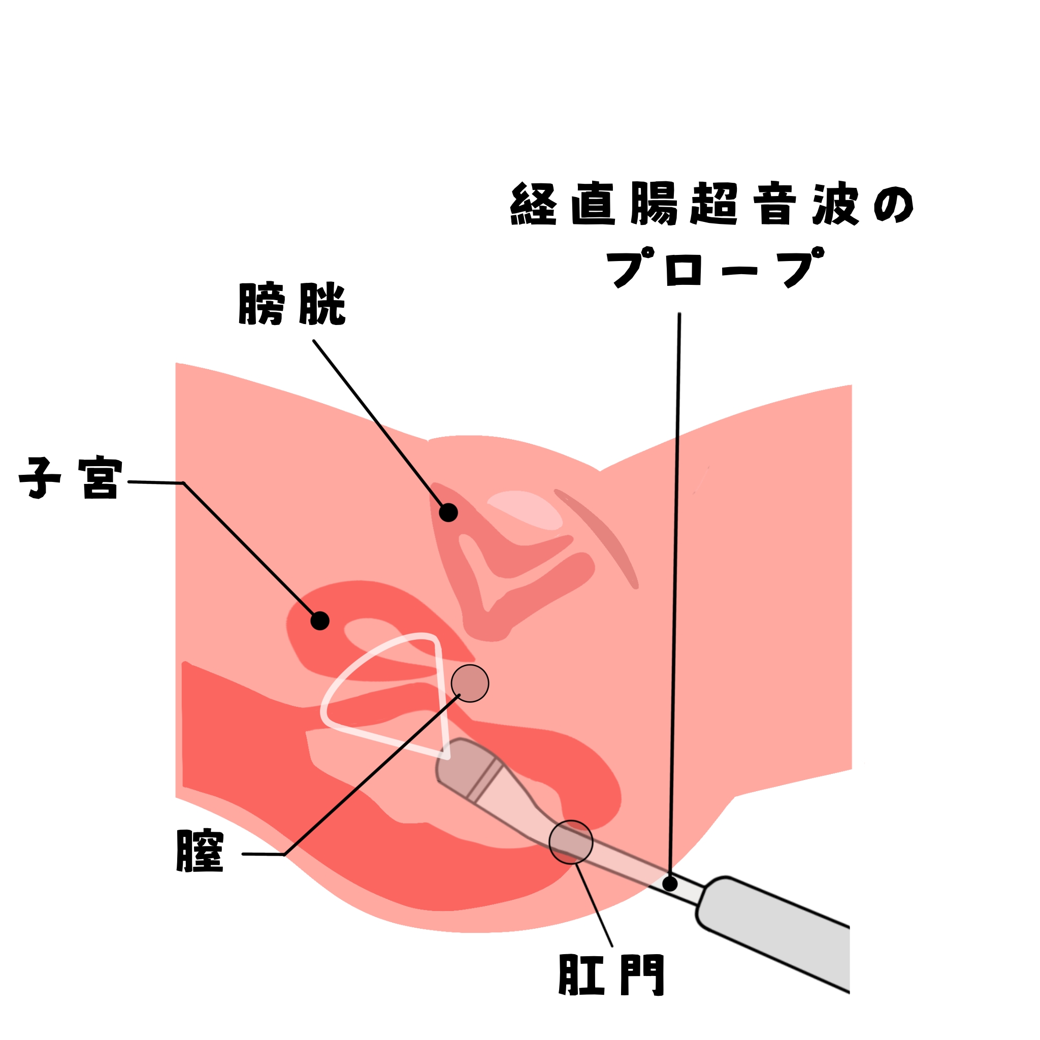 経直腸超音波検査