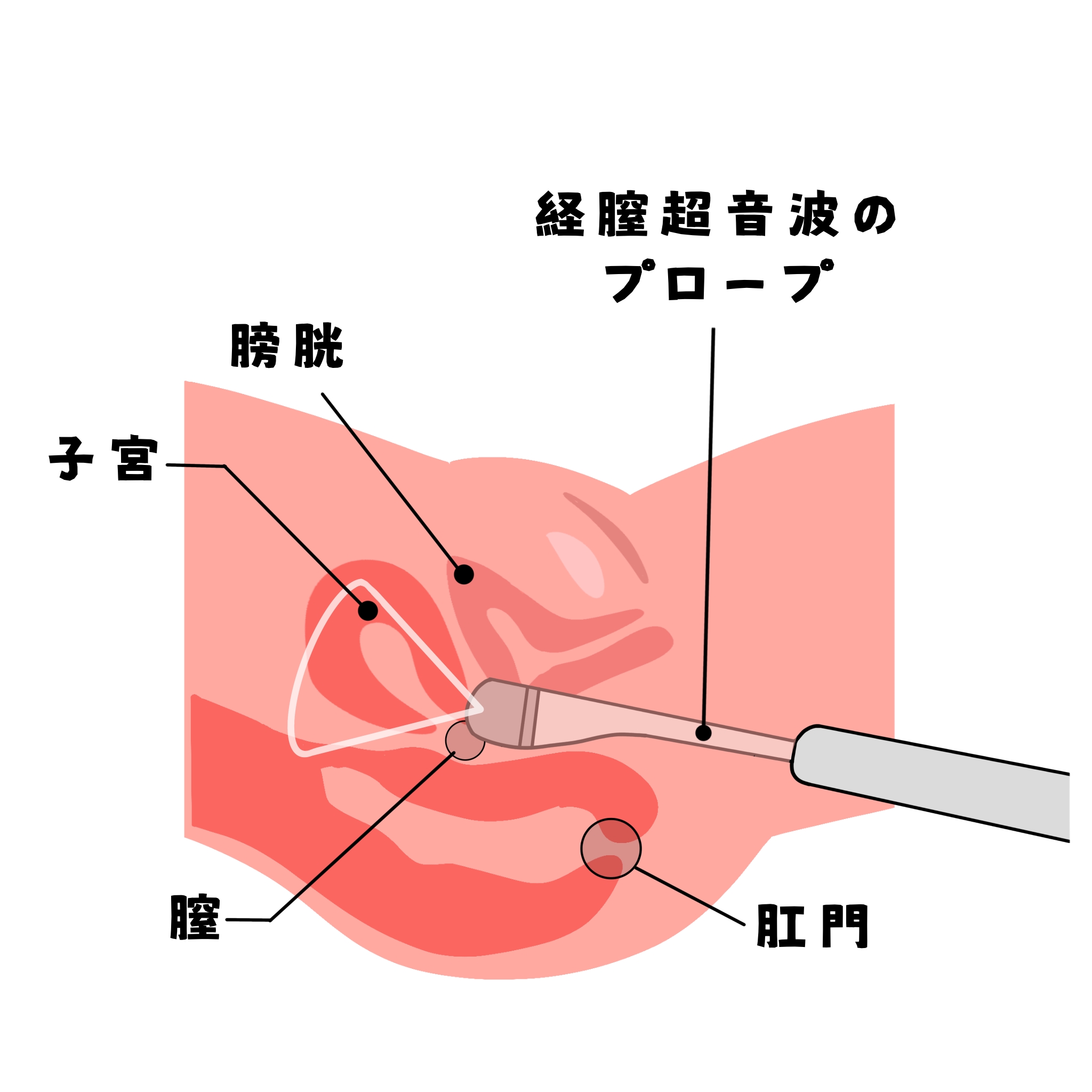 経腟超音波検査